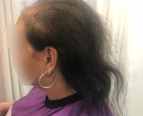 Hair Loss Solutions - Stoke