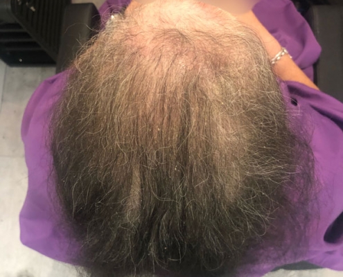 Hair Loss Solutions - Stoke